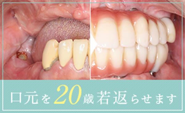 口元を20歳若返らせます